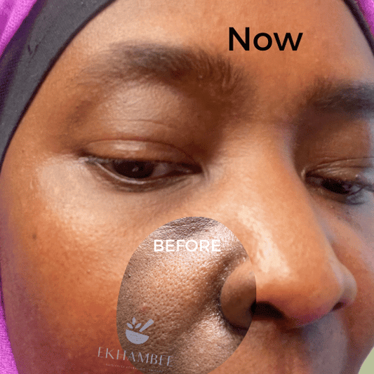 Before and After: Close-up of cheeks with large pores and bumps (‘Before’) vs. clear, glowing skin (‘NOW’). Results from avoiding blemish-causing foods and using Ekhambee products.