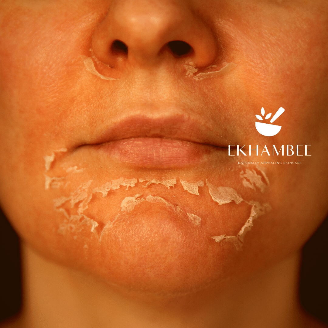 chemical peel on face