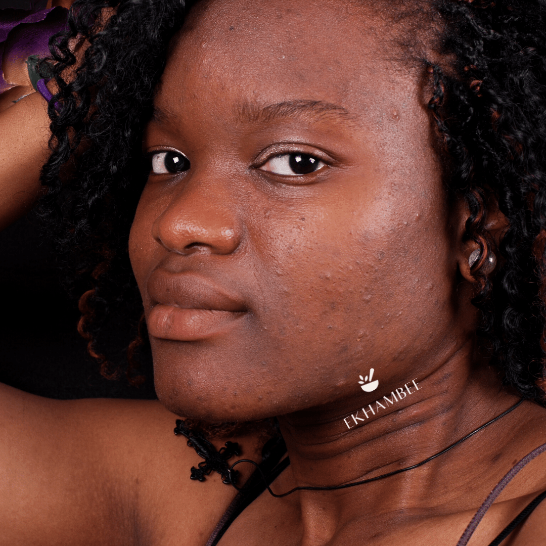 Black woman with acne blemishes, uneven skin, dark eye circles with curly hair and ekhmabee logo