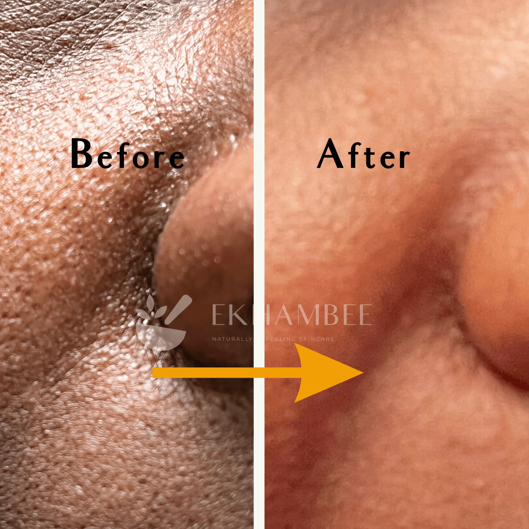 shrink pores on cheeks | before and after pictures | Ekhambee